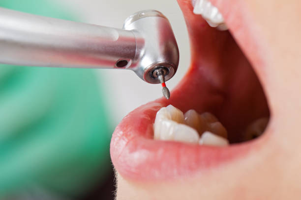Best Urgent Care for Lost Fillings or Crowns in Las Flores, CA